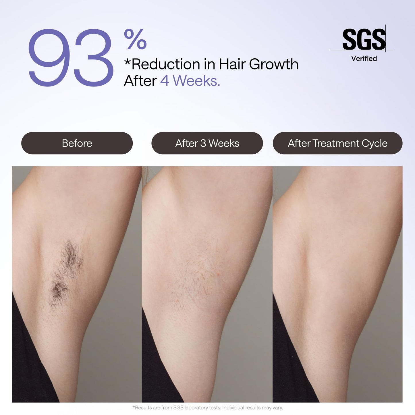 Ulike Air 4 IPL, ice-cooling, fast 10min sessions, home hair removal