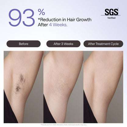 Ulike Air 4 IPL, ice-cooling, fast 10min sessions, home hair removal