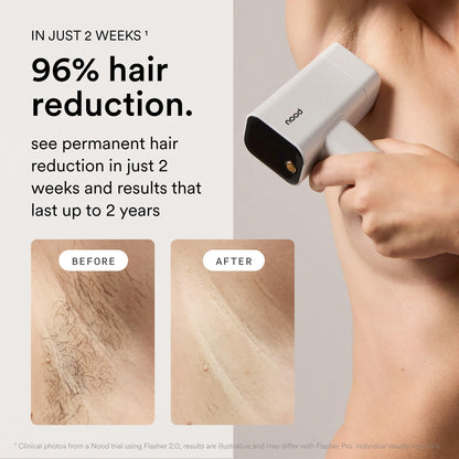 Nood Flasher Pro + serum, IPL device with slow hair regrowth formula
